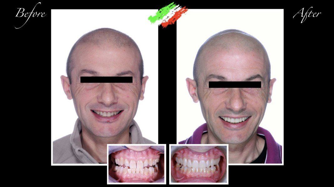 Impianto dentale ad arcata superiore