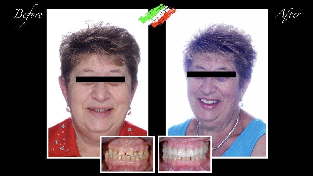 Ricostruzione di arcata dentale superiore e inferiore