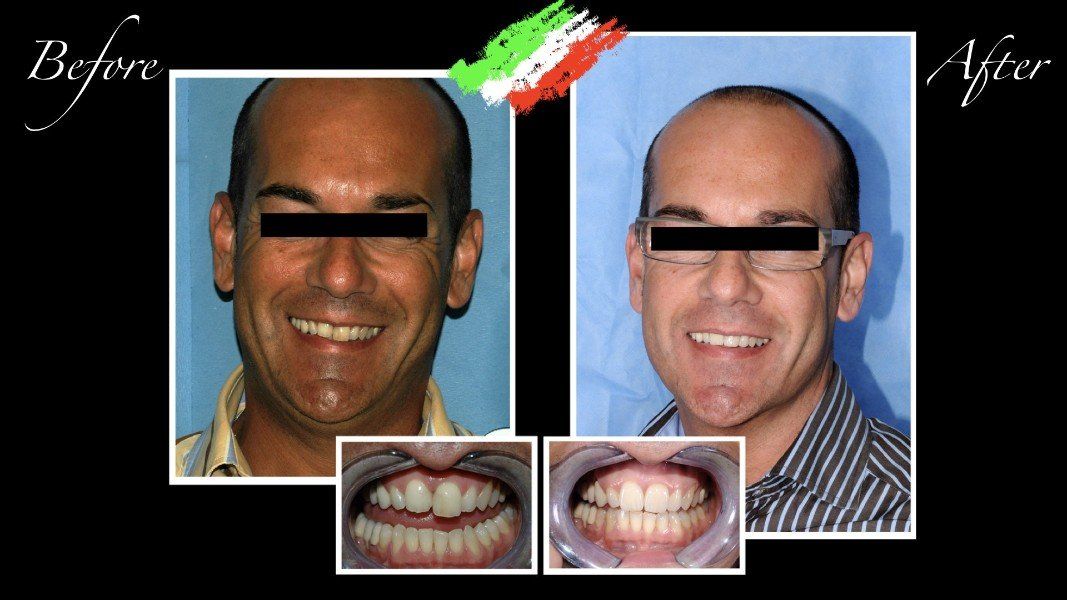 Intervento di implantologia