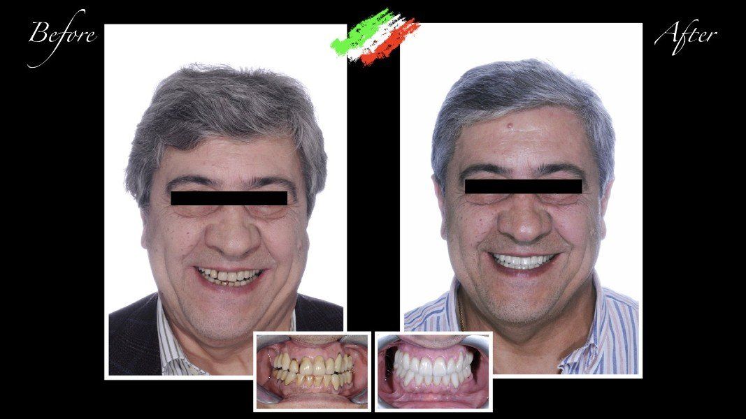 Realizzazione di protesi dentarie