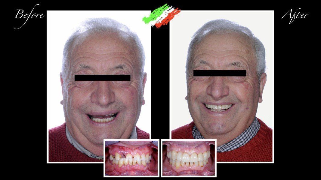 paziente prima e dopo la ricostruzione dei denti