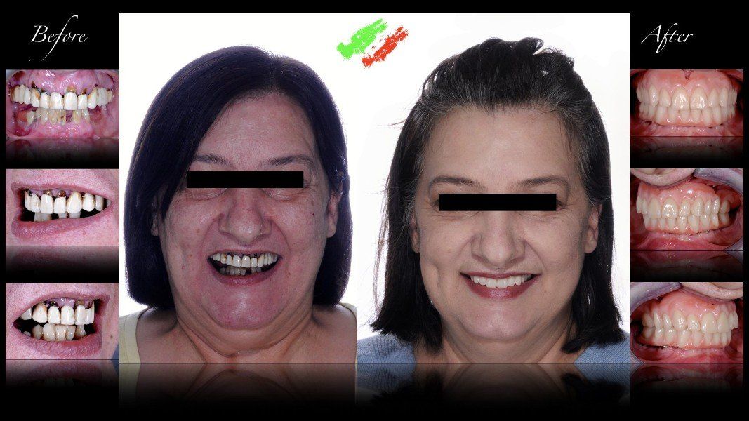 Intervento di implantologia