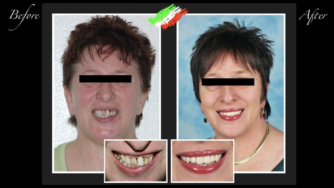 Intervento di ricostruzione dentale