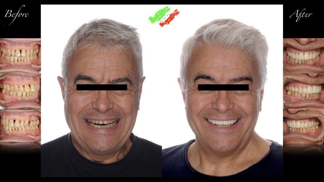 Allineamento dentale