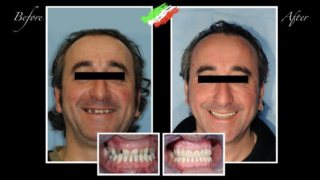 Ricostruzione di arcate dentali