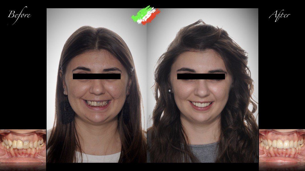 paziente prima e dopo intervento endodontico