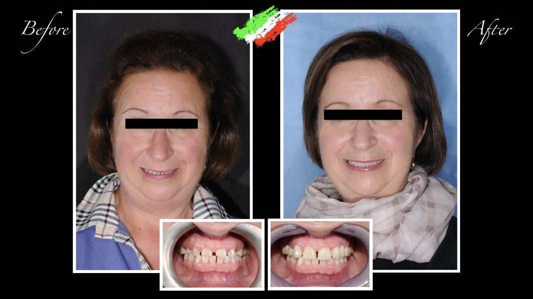 paziente prima e dopo intervento di ricostruzione denti
