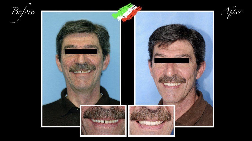 paziente prima e dopo ricostruzione dentale