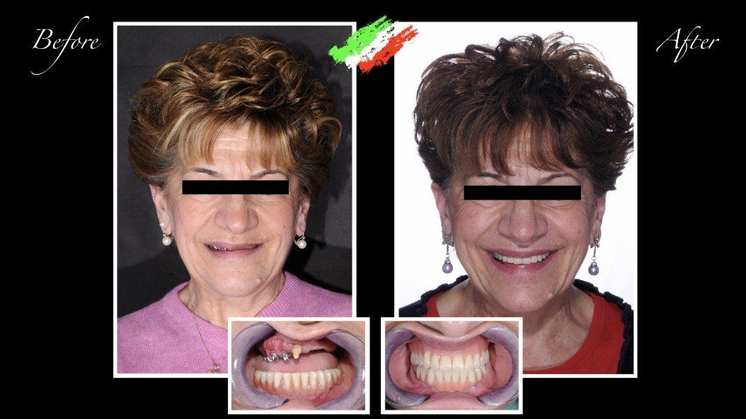 paziente prima e dopo intervento ad arcata dentale superiore