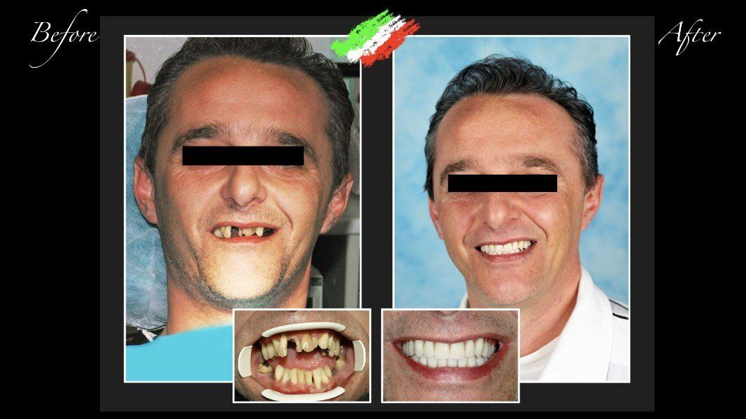 paziente prima e dopo intervento di implantologia