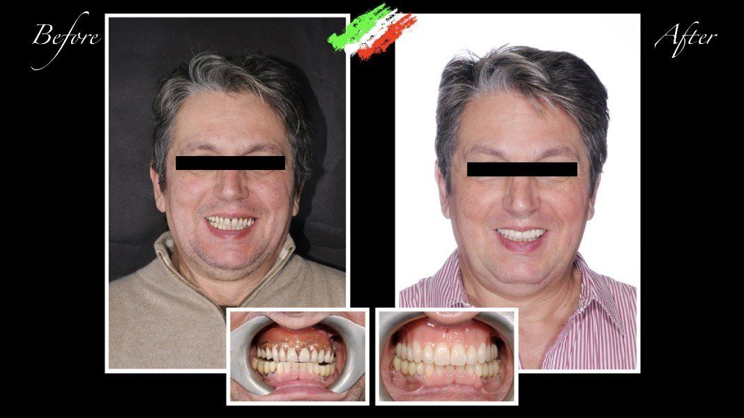 paziente prima e dopo intervento ortodontico