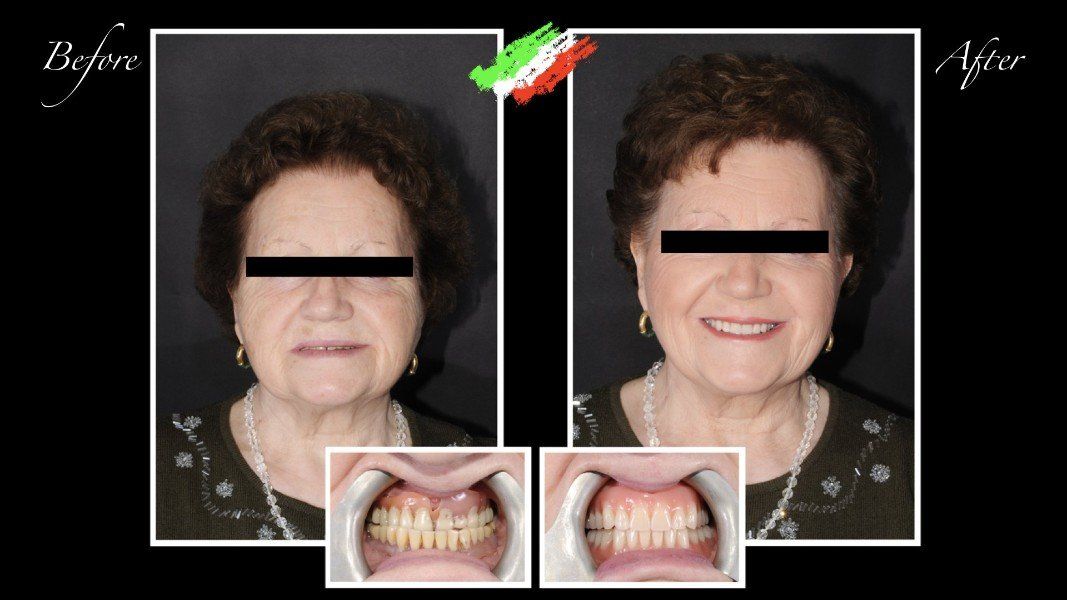 paziente prima e dopo intervento di odontoiatria
