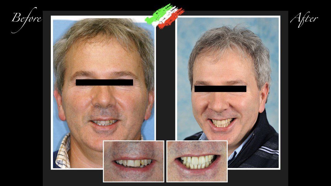 paziente prima e dopo intervento odontoiatrico
