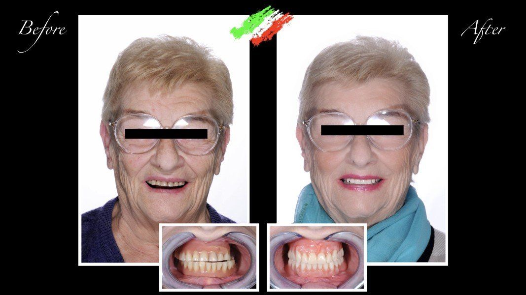 paziente anziana prima e dopo intervento dentistico