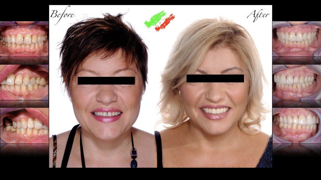 Una paziente prima e dopo intervento dentistico