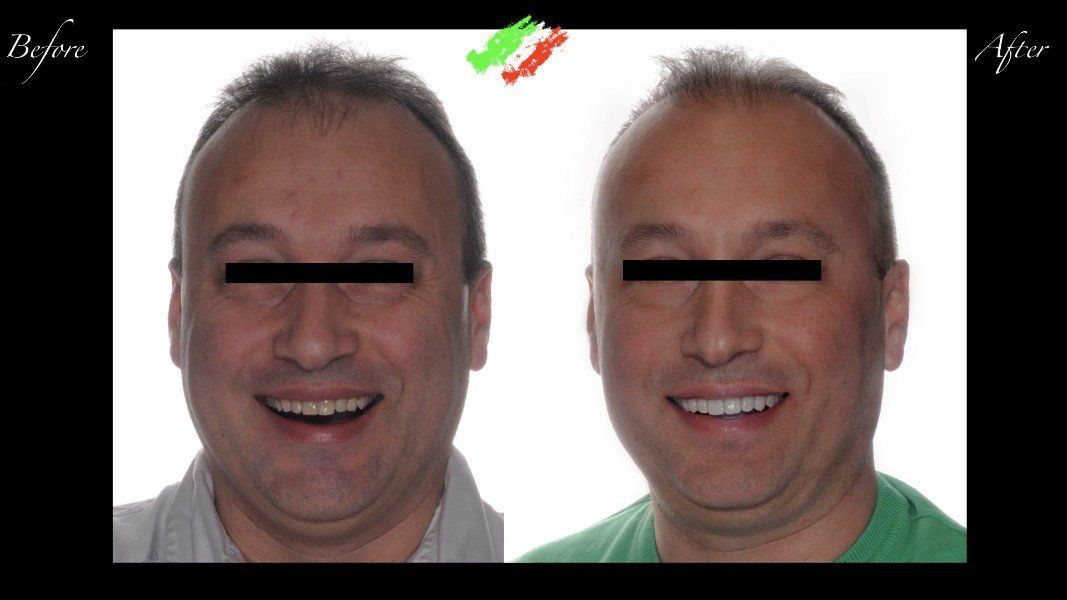 paziente prima e dopo intervento dentistico