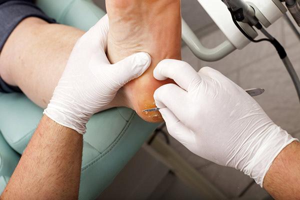 CASA DR. SCHOLL TOLUCA - Onicomicosis