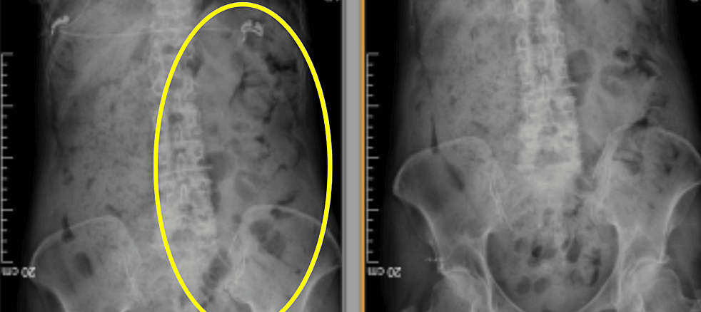 A black and white x-ray of a person 's stomach with a yellow circle around it