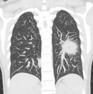 A black and white ct scan of a person 's lungs.