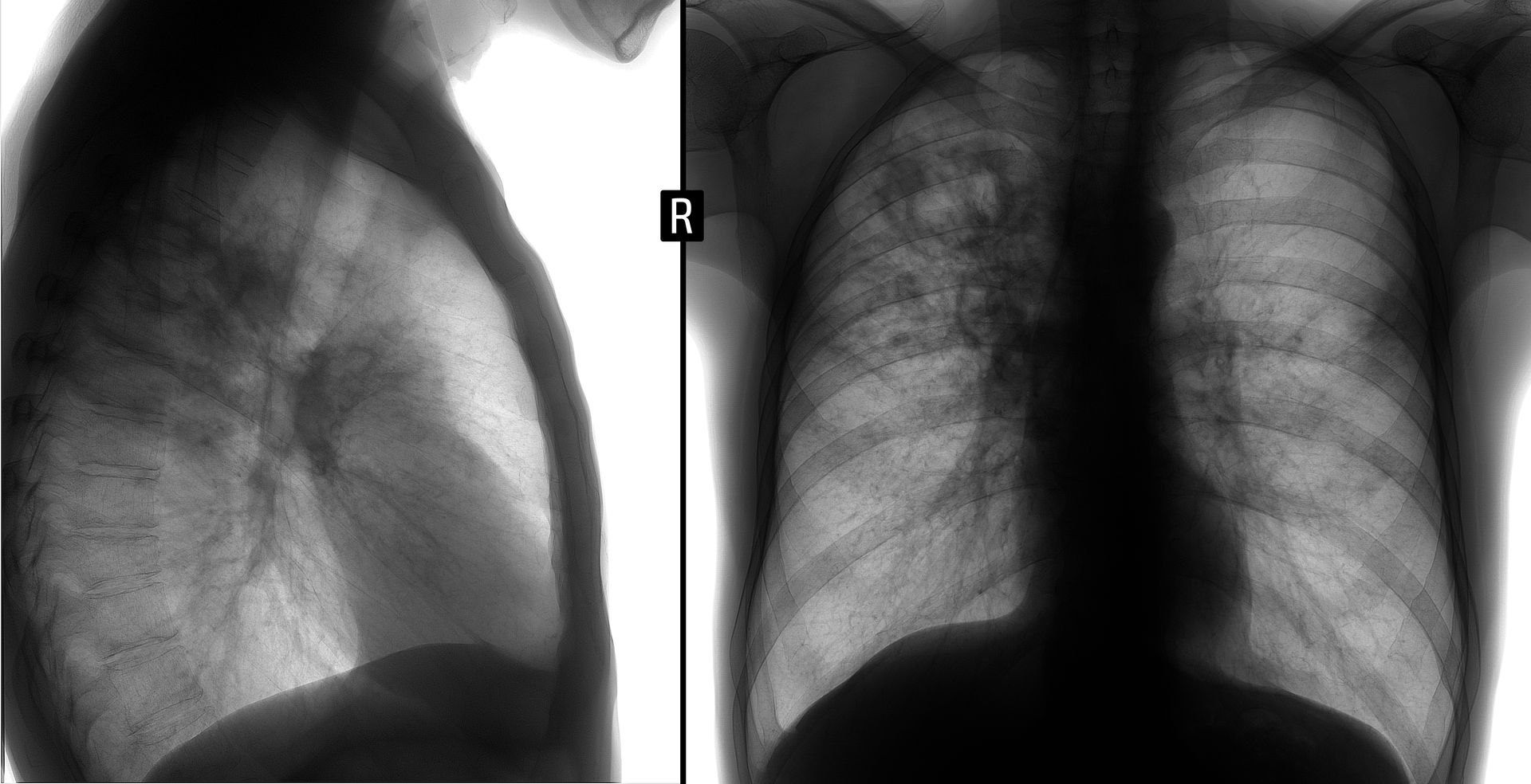 Chest X-ray showing a lateral view on the left and a posterior-anterior view on the right, highlighting lung tissue.