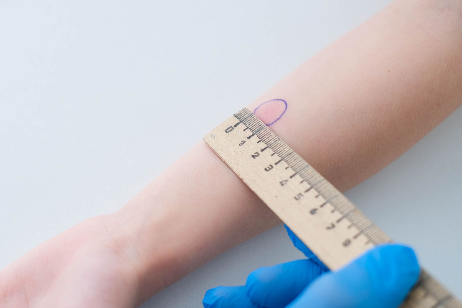 A gloved hand uses a ruler to measure a marked, oval-shaped area on a person's forearm.