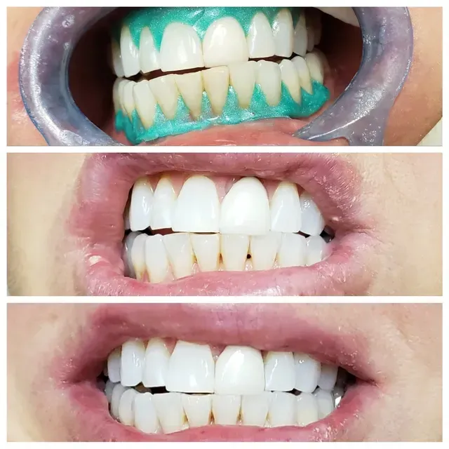 Teeth whitening process: before, during (with blue gel), and after, showing progressively whiter teeth.