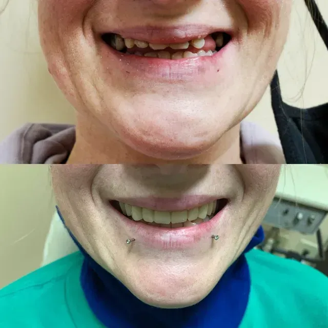 Top: woman's teeth are crooked. Bottom: same woman, straight teeth, lip piercings, smiling.
