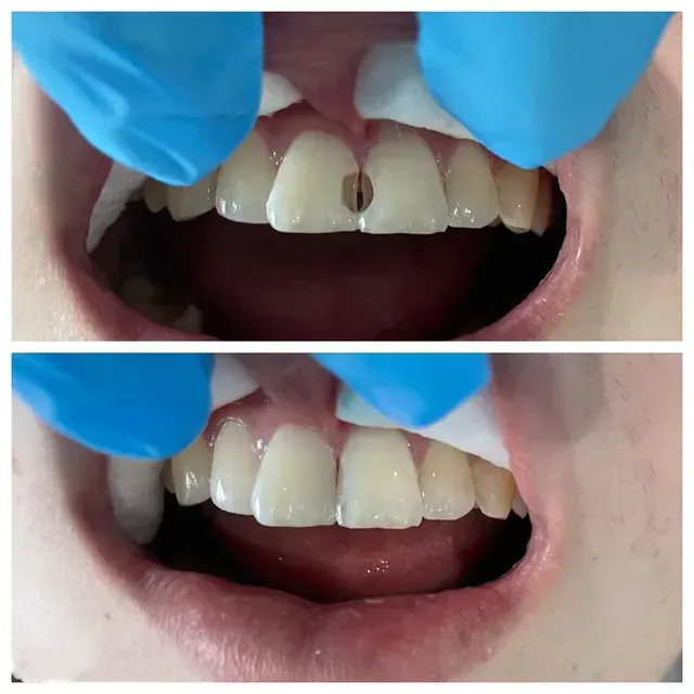 Top: Teeth with a dark spot, dental procedure. Bottom: Teeth after filling.