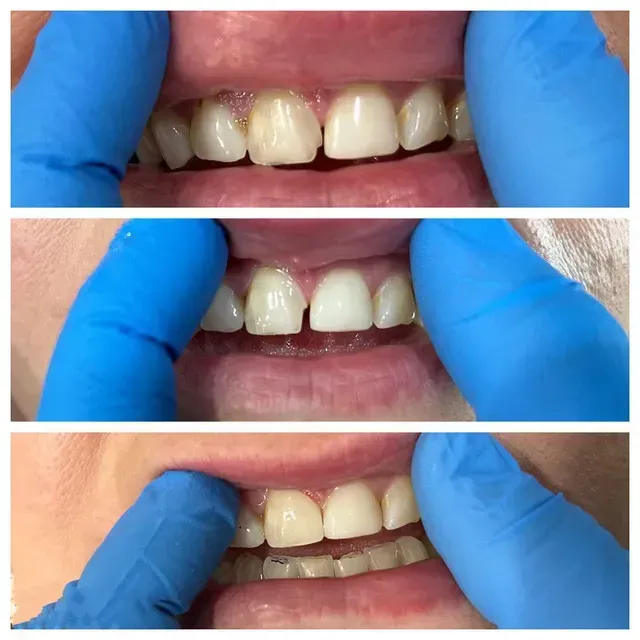 Teeth before and after whitening. Hands with blue gloves hold mouth open.