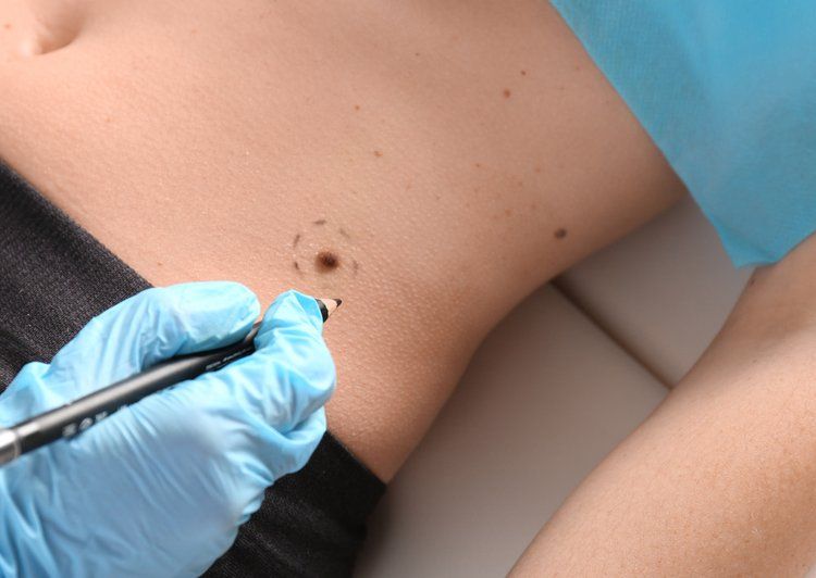 A Doctor Is Drawing A Spot On A Patient's Skin — Health Hub Mackay in Mackay, QLD