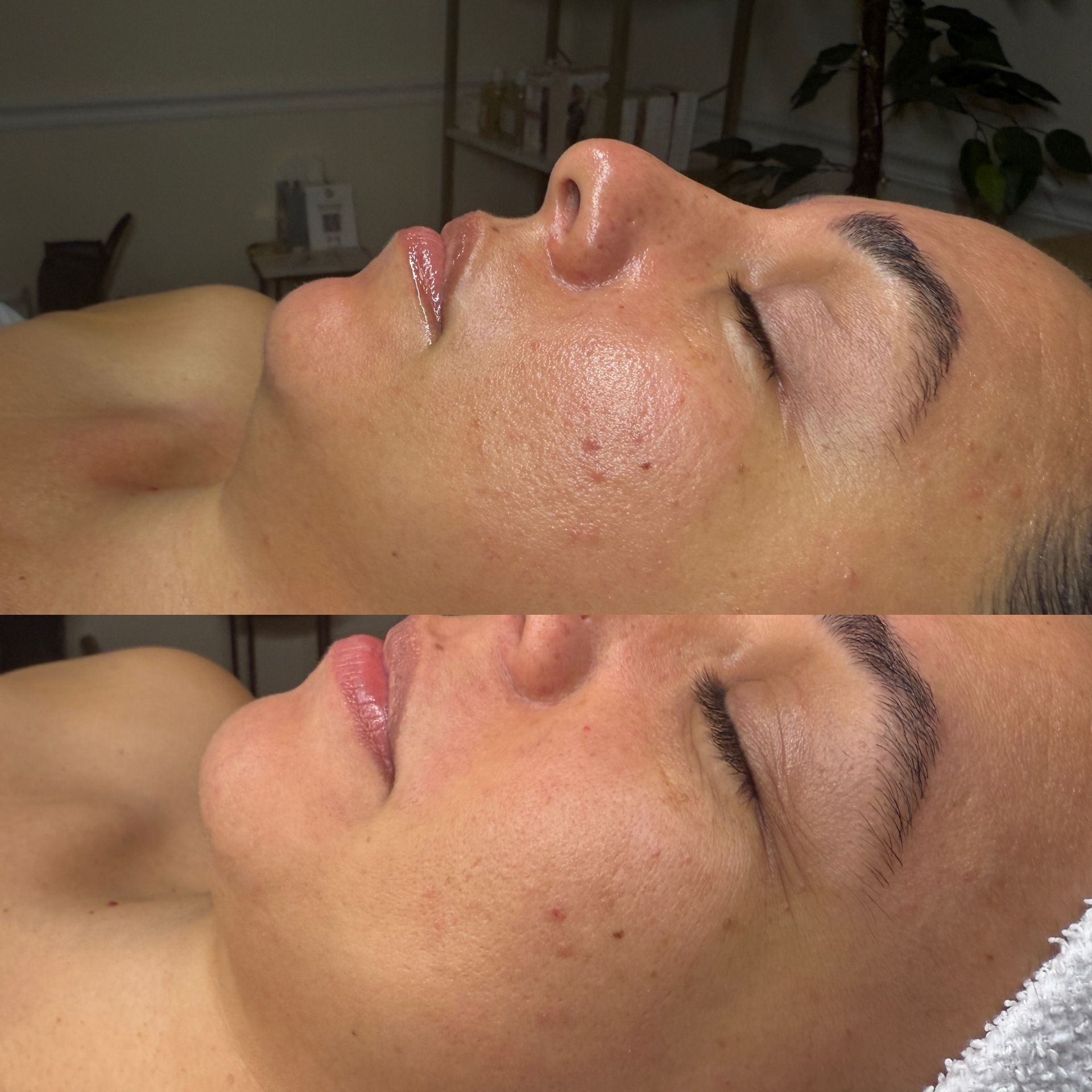 Side-by-side view of a person's face before (top) and after (bottom) a skincare treatment.