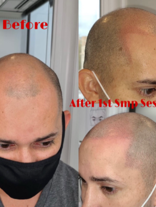 Before and after scalp micropigmentation session on a man. Bald scalp, close-up. Skin tones vary. Facial expressions neutral.