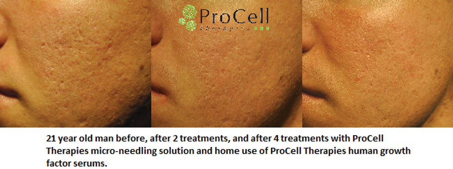 After 2 Procell Treatments