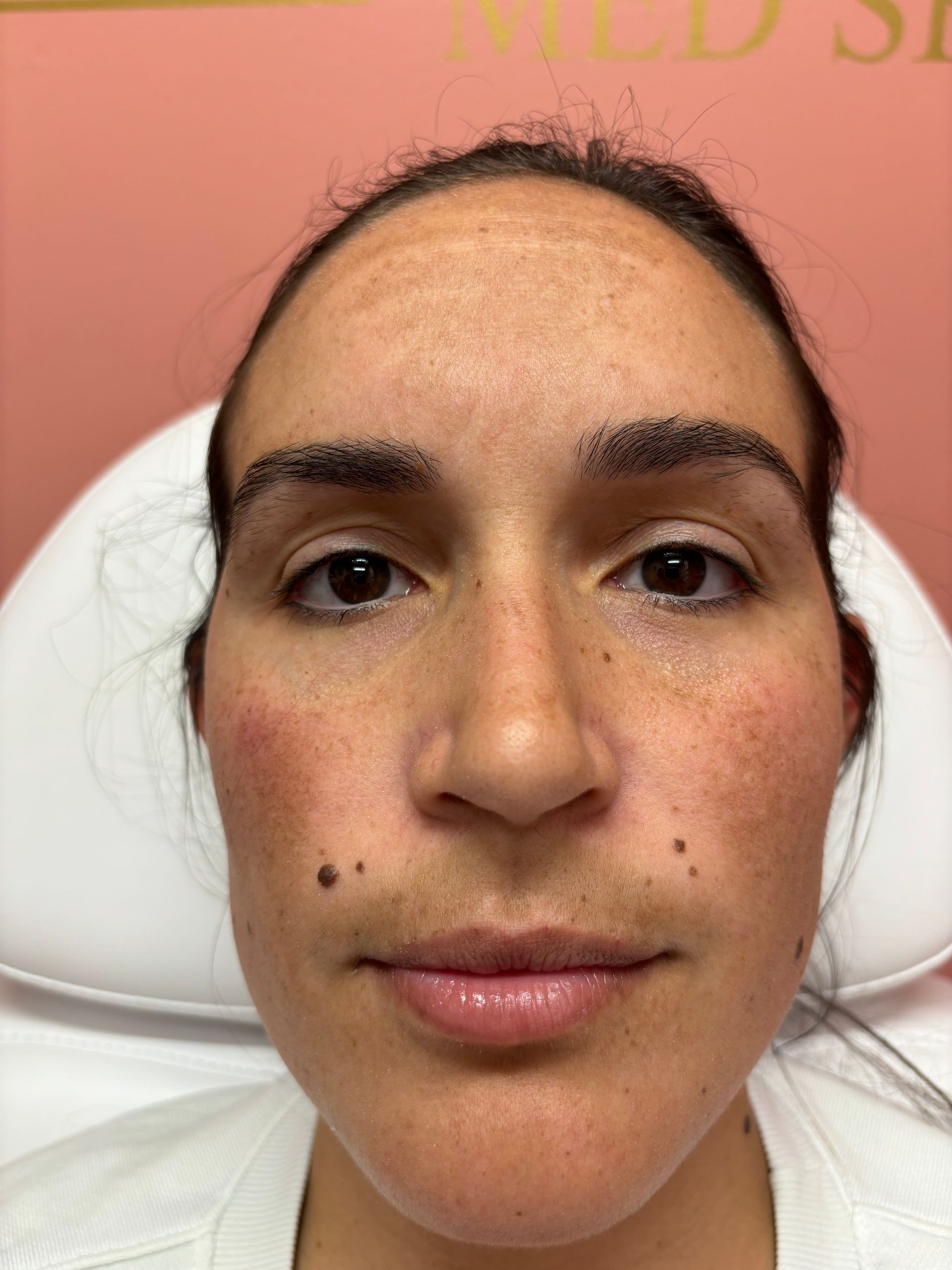 A close up of a woman 's face with freckles.