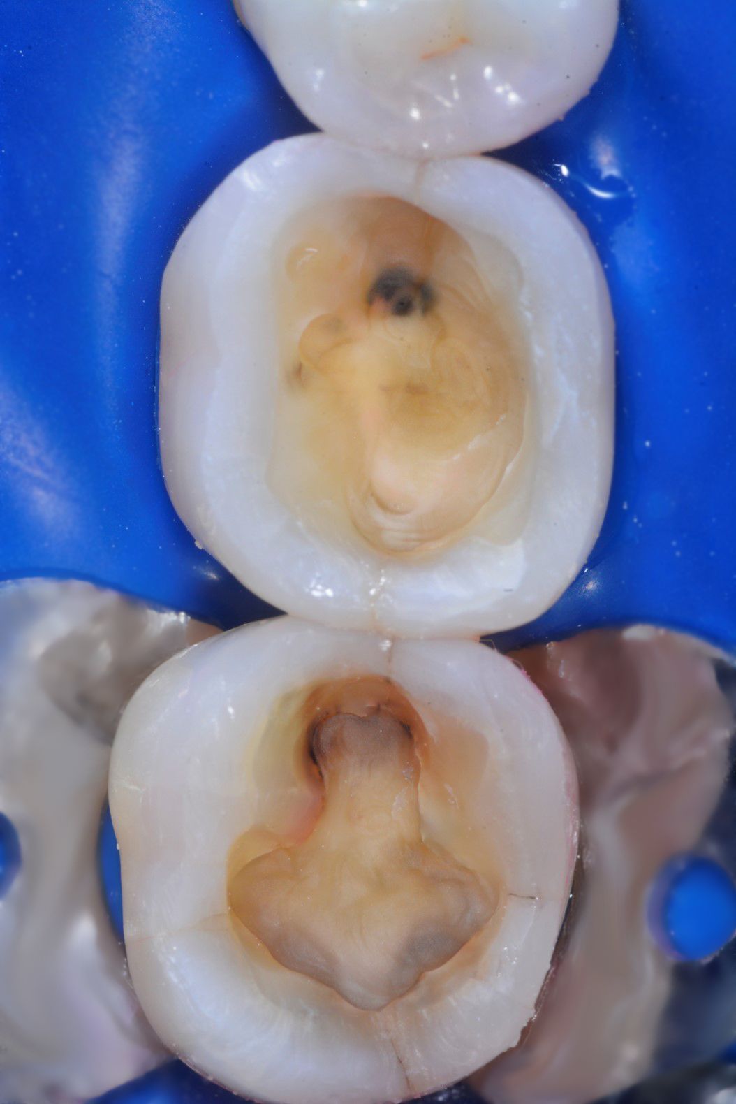 Top-down view of two teeth cavities prepped for fillings, showing the inner structure, with a blue rubber dam | Ogden, UT | Pleasant Valley