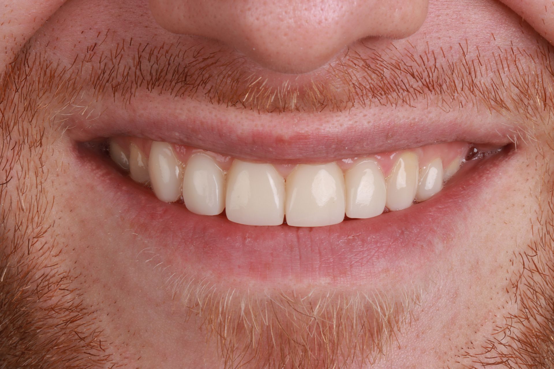 Close-up of a smiling mouth with straight, white teeth | Ogden, UT | Pleasant Valley Close-up of a smiling mouth with straight, white teeth | Ogden, UT | Pleasant Valley
