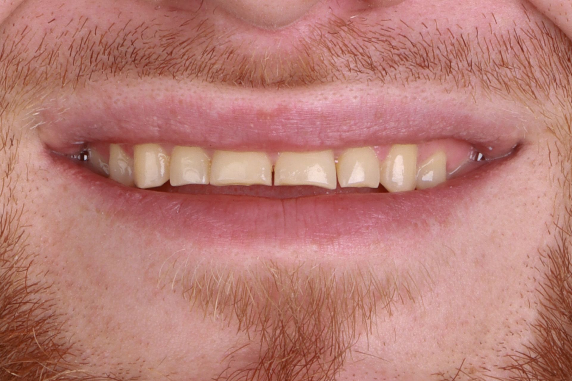 Close-up of a smiling mouth with yellowed teeth and a beard | Ogden, UT | Pleasant Valley Close-up of a smiling mouth with yellowed teeth and a beard | Ogden, UT | Pleasant Valley