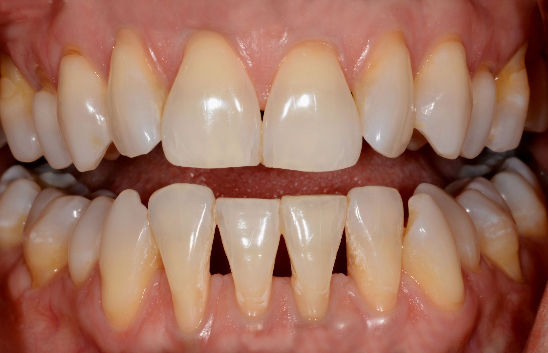Close-up of a person's teeth, showing upper and lower rows | Ogden, UT | Pleasant Valley