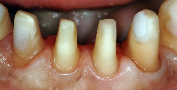 Close-up of prepared teeth, yellowish color, in a dental patient's mouth, ready for crowns or veneers