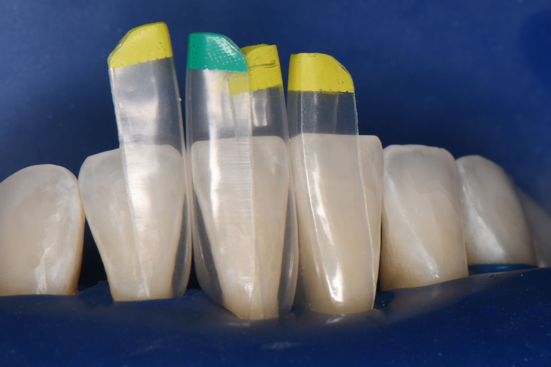 Teeth with clear dental matrices and colored tabs, isolated in a blue field, preparing for cosmetic work | Ogden, UT | Pleasant Valley Teeth with clear dental matrices and colored tabs, isolated in a blue field, preparing for cosmetic work | Ogden, UT | Pleasant Valley