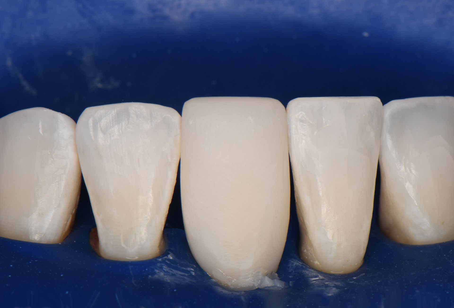 Close-up of teeth with a blue dental dam; teeth are prepped for cosmetic dental work, appearing white and smooth | Ogden, UT | Pleasant Valley