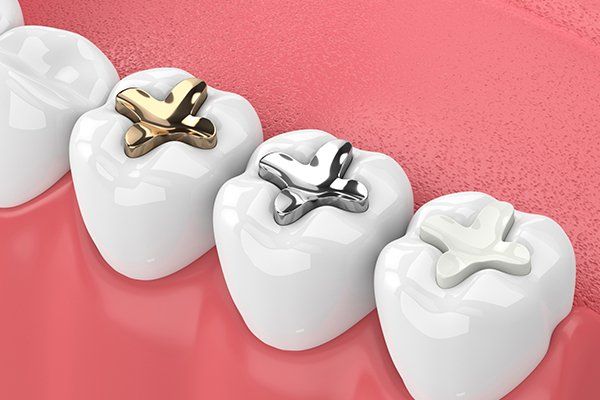 Tooth Colored Fillings — Antioch, CA — New City Dental Practice