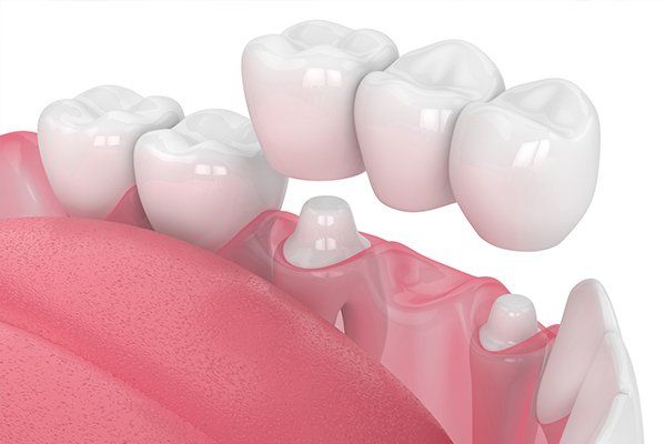 Dental Crowns — Antioch, CA — New City Dental Practice