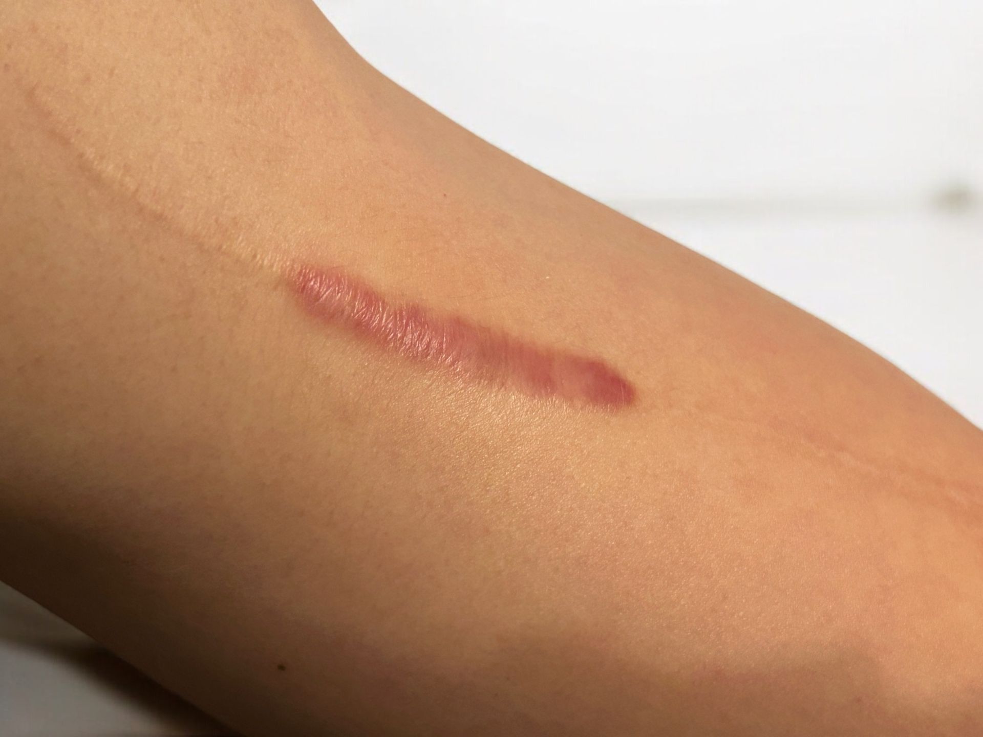 A close up of a scar on a person 's arm.