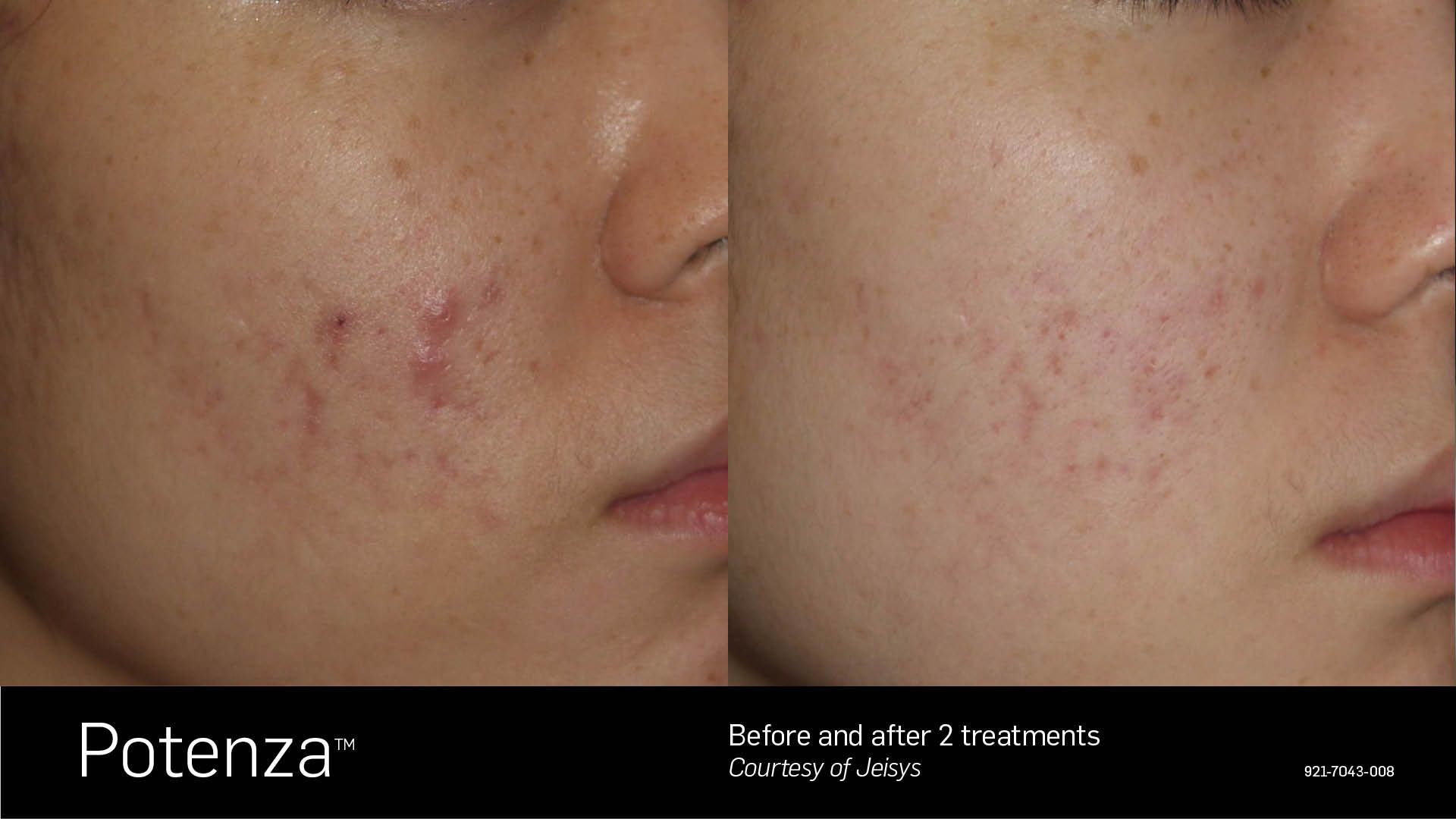 A before and after photo of a woman 's face with acne