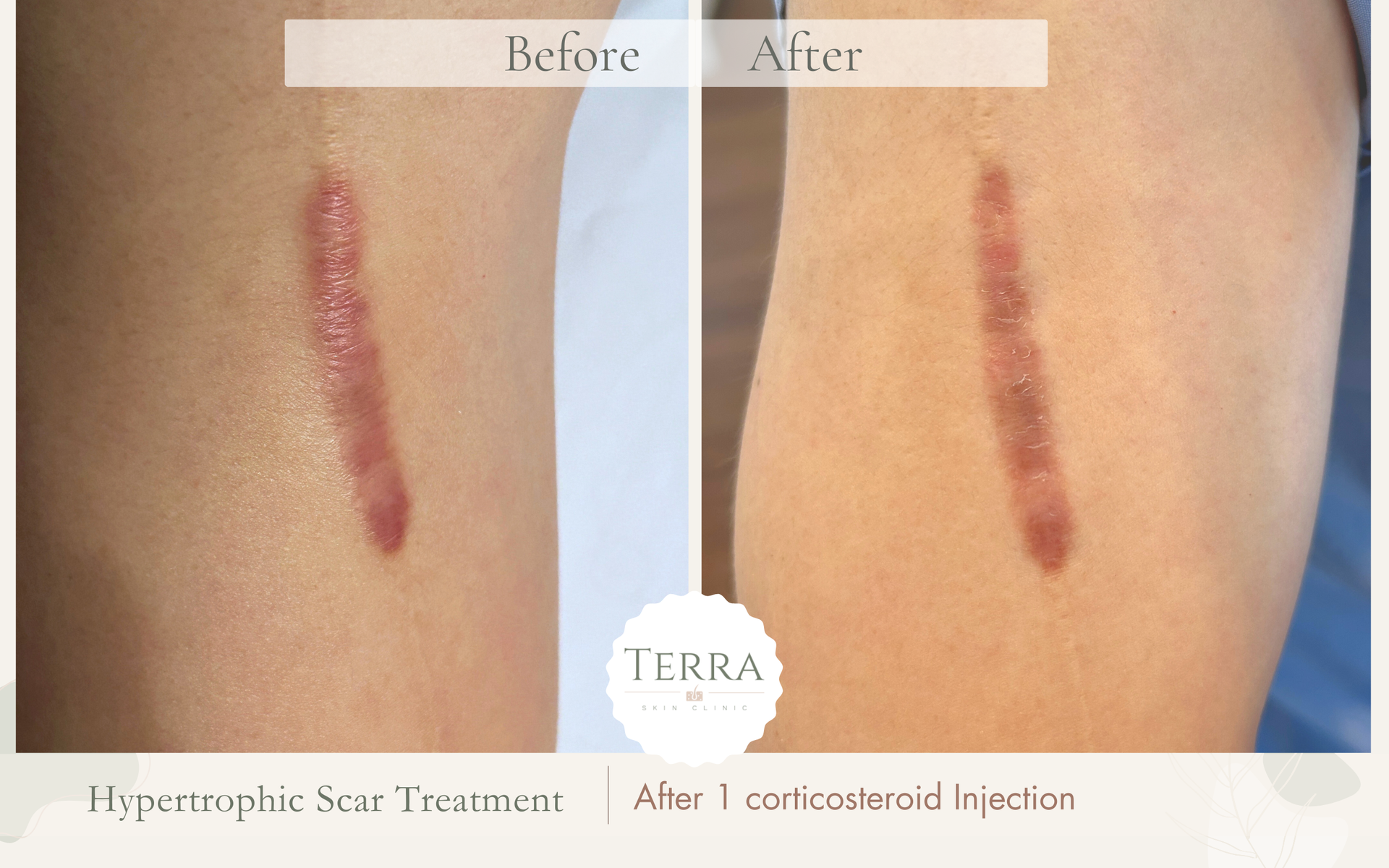 A before and after photo of a scar on a person 's arm.