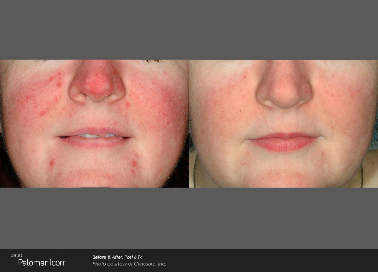 A before and after photo of a woman 's face with red spots on it.