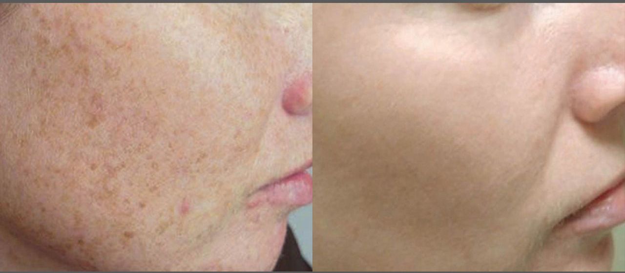 A before and after photo of a woman 's face with freckles.