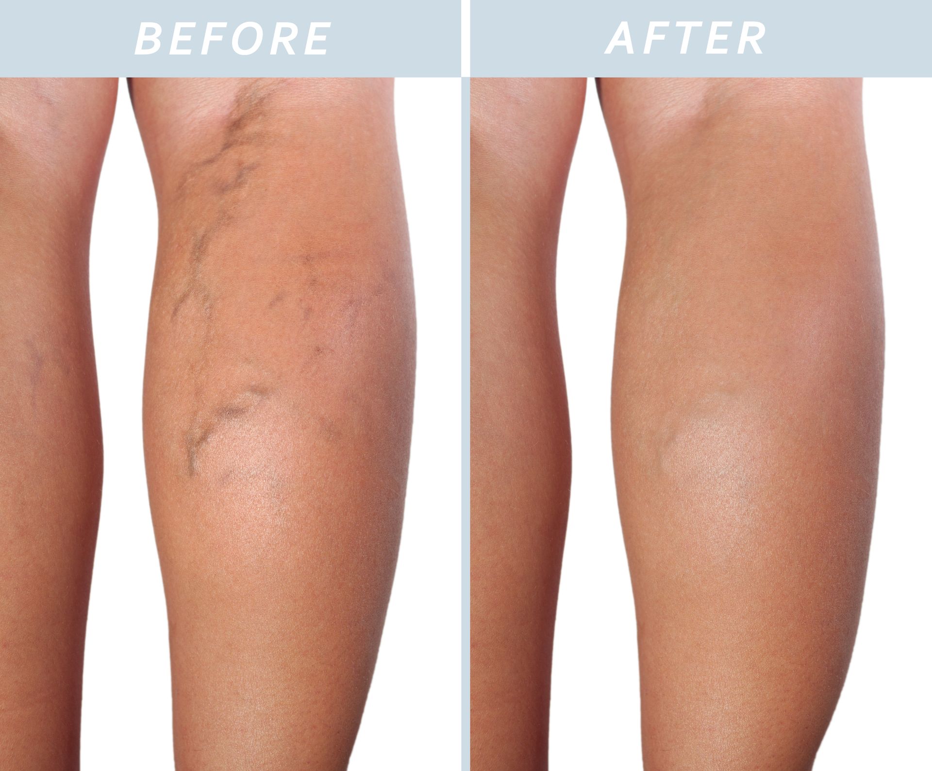 A before and after photo of a woman 's legs with varicose veins