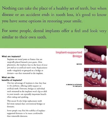 Implants — Tooth Extraction in Wausau, WI